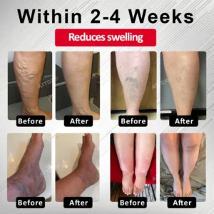 ATTDX® Advanced CVI Edema Therapy Cream