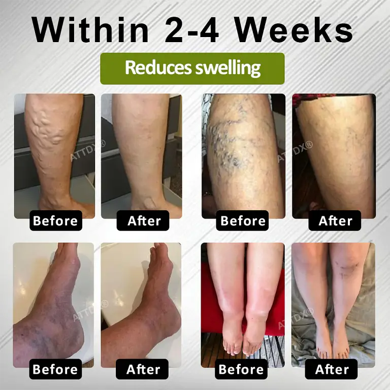 ATTDX® EdemaFree Flow Drain Massage Cream