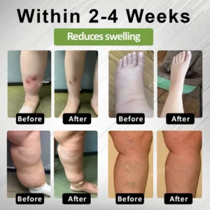 ATTDX® Edema Drain Duo Therapy Roller Cream