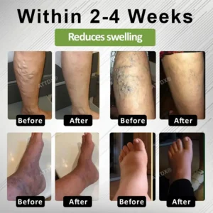 ATTDX® Edema Drain Duo Therapy Roller Cream