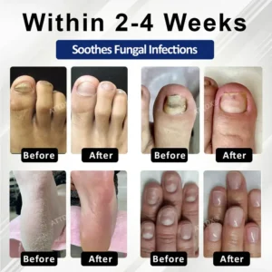 ATTDX® FungaGuard Botanica Roll On Stick