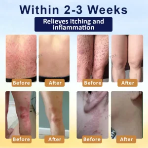 Cvreoz® PsoriasisCare Mellifera Venom Skin Healing Spray