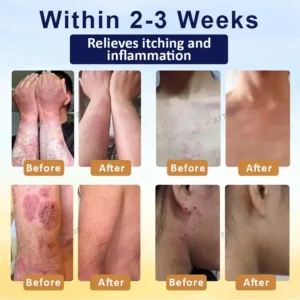 Cvreoz® PsoriasisCare Mellifera Venom Skin Healing Spray