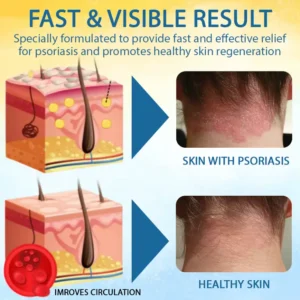 Cvreoz® PsoriasisCare Mellifera Venom Skin Healing Spray