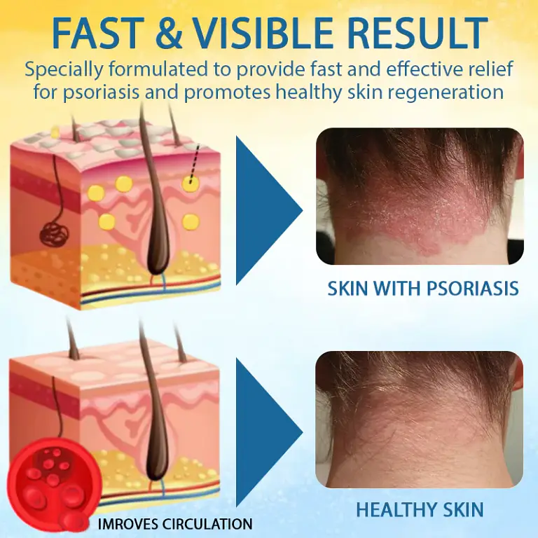 Cvreoz® PsoriasisCare Mellifera Venom Skin Healing Spray