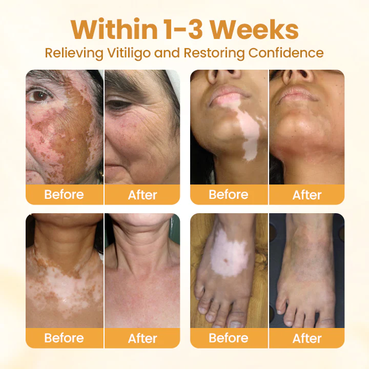 Timilk® VitiCalm Bee Venom Cream