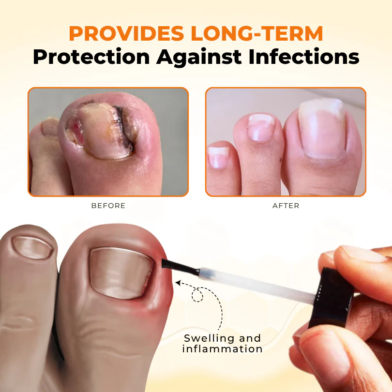 Timilk® NailRevive Bee Venom Anti-fungi Solution 3 Timilk® NailRevive Bee Venom Anti-fungi Solution