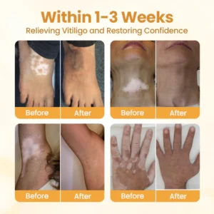 Timilk® VitiCalm Bee Venom Cream