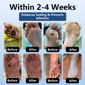 DiabeHeal™ Diabetic Skin Healing Cream