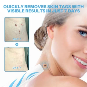 Fivfivgo® Painless At-home Skin Tag Removal Pen