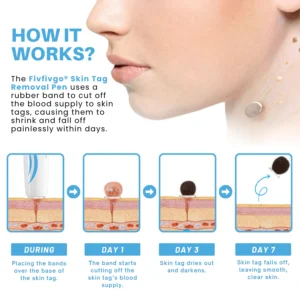 Fivfivgo® Painless At-home Skin Tag Removal Pen