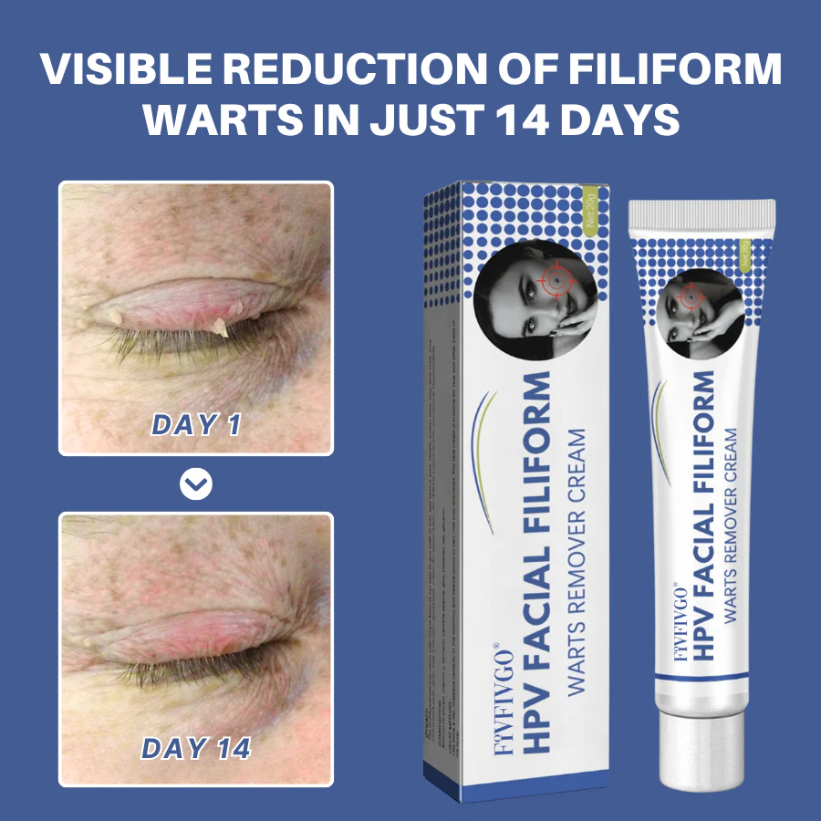 Fivfivgo® HPV Facial Filiform Warts Removal Cream 5 Fivfivgo® HPV Facial Filiform Warts Removal Cream