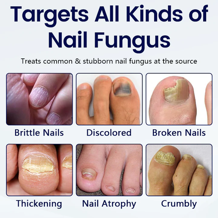Timilk® Anti-Fungal Nail Repair Patch 5 Timilk® Anti-Fungal Nail Repair Patch