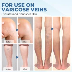 Timilk® TheraVein Varicose Herbal Spray 9 Timilk® TheraVein Varicose Herbal Spray