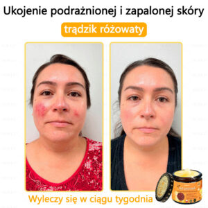 Foulme® Professional Bee Venom Removal Cream