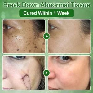 Skavix™ Tea Tree Oil Skin Treatment Cream