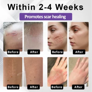 ATTDX® ClearScar Advanced Therapy Spray