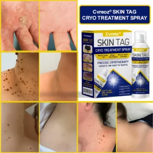 Cvreoz® Skin Tag Cryo Treatment Spray image Cvreoz® Skin Tag Cryo Treatment Spray