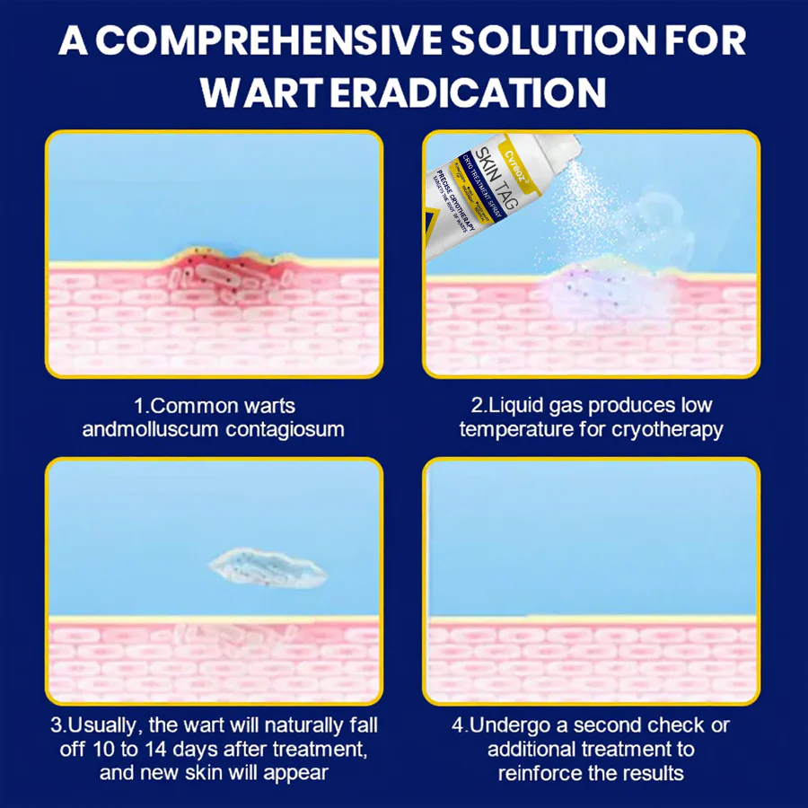 Cvreoz® Skin Tag Cryo Treatment Spray image Cvreoz® Skin Tag Cryo Treatment Spray