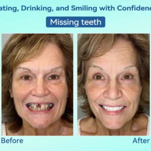 Tiworld® Premium Denture image Tiworld® Premium Denture