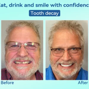 Tiworld® Premium Denture image Tiworld® Premium Denture