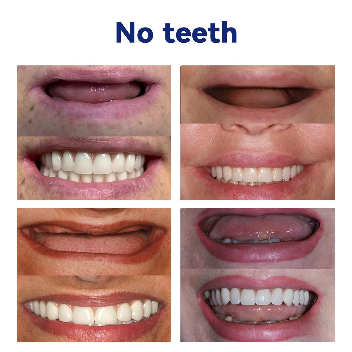 DIYSTAR™ Silicone Reline Denture Set