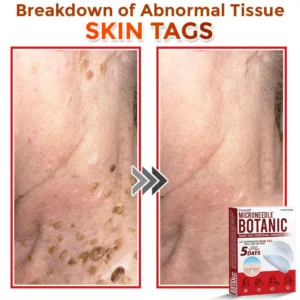 Cvreoz® MicroNeedle Botanic Skin Tag Removal Patch