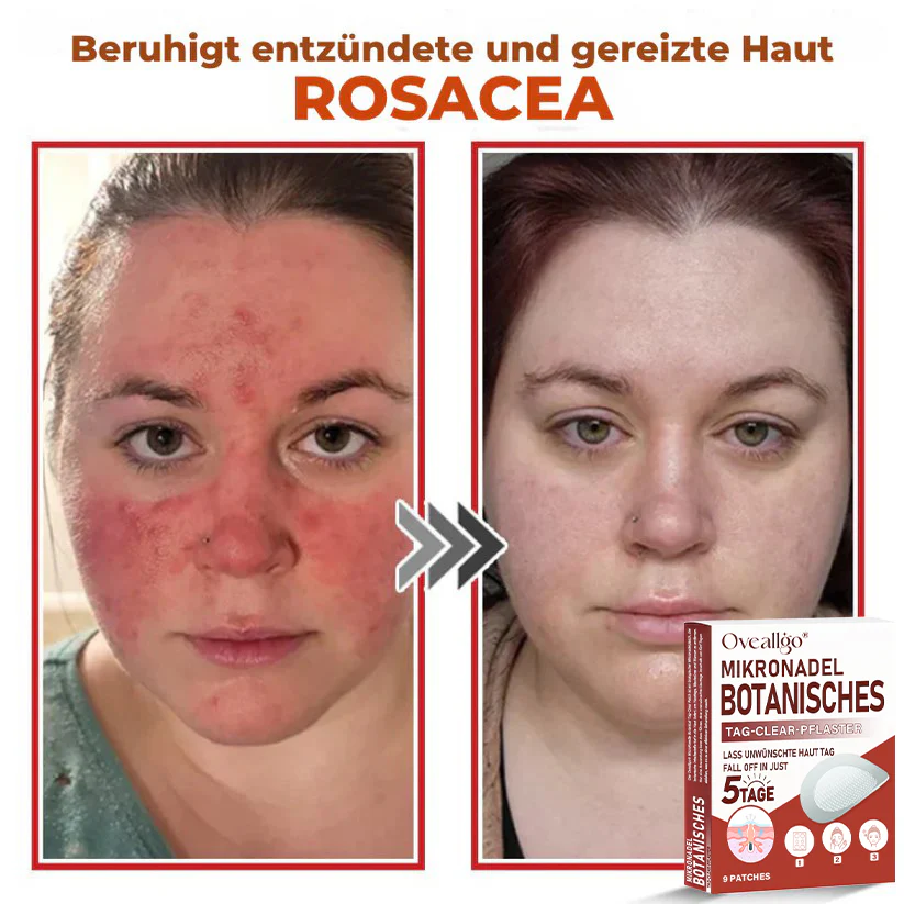 Oveallgo® MicroNeedle PLUS Botanical Day Clear Patch