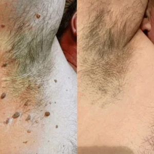 Biopure Skin Removal Spray