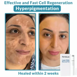 FerméLuxe Wart Removal Laser Pen