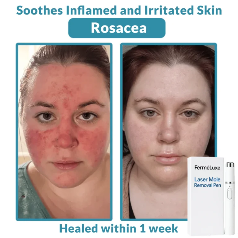FerméLuxe Wart Removal Laser Pen