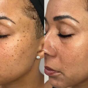 Hermsa® non-invasive laser pointer