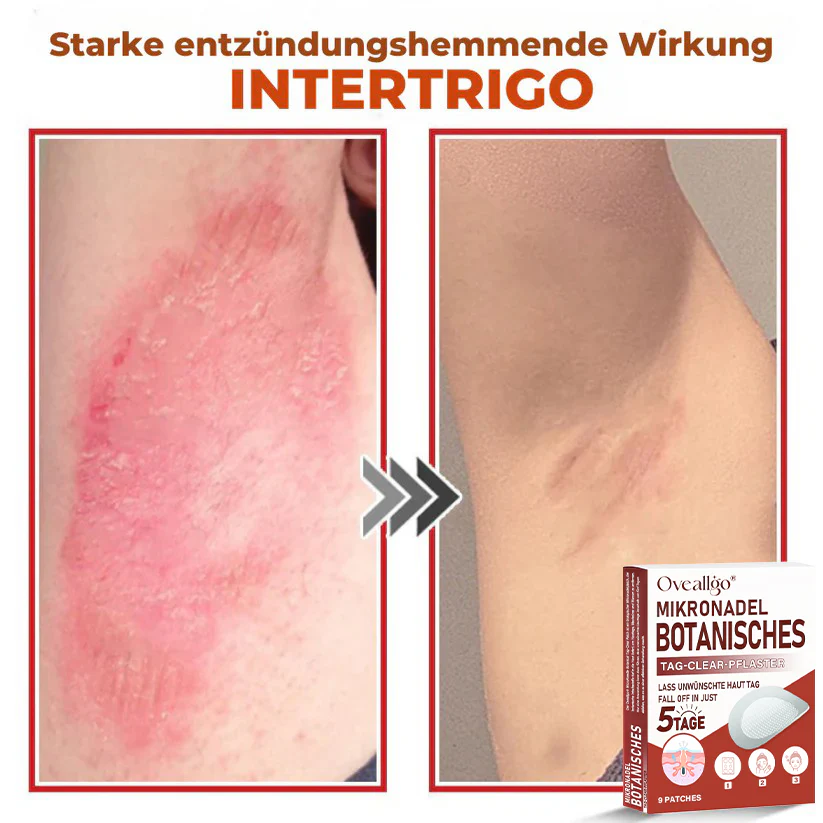 Oveallgo® MicroNeedle PLUS Botanical Day Clear Patch