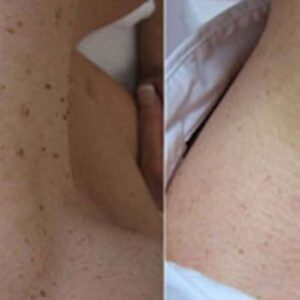 Hermsa® non-invasive laser pointer