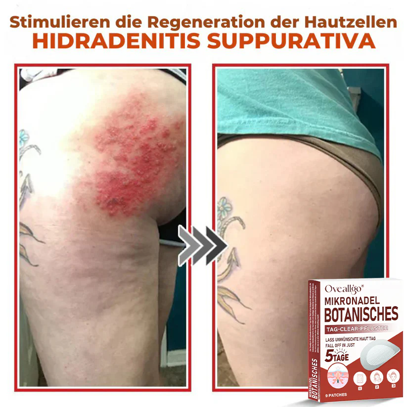 Oveallgo® MicroNeedle PLUS Botanical Day Clear Patch