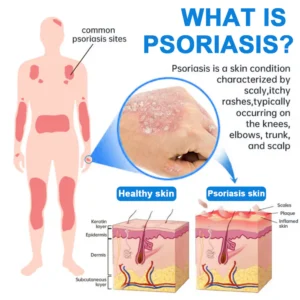 ADNOON Natural Magnesium Herbal Psoriasis Spray