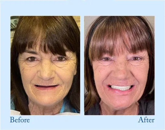 Hidone®Advanced Denture Kit with Custom Dentures