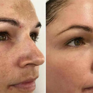 MelantraX – Advanced essence against pigmentation spots