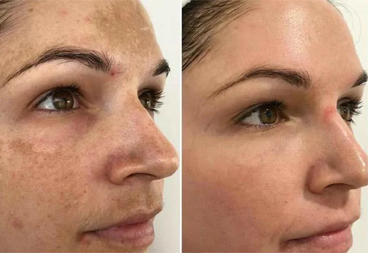 MelantraX – Advanced essence against pigmentation spots