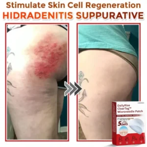 DailyRise ClearTag™ Microneedle Patch