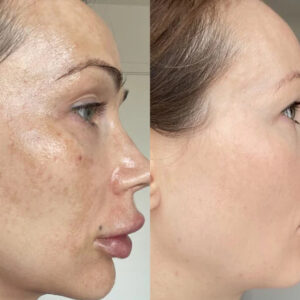 MelantraX – Advanced essence against pigmentation spots