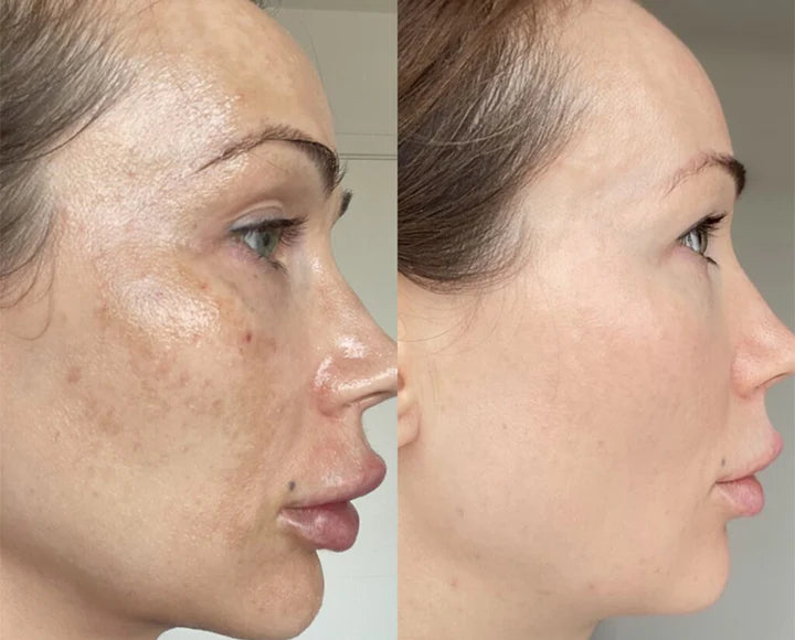 MelantraX – Advanced essence against pigmentation spots