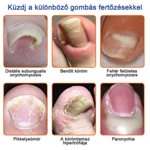 Furzero™ Bee Venom Nail Fungus Treatment Solution image Furzero™ Bee Venom Nail Fungus Treatment Solution