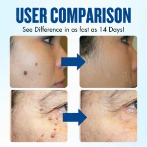 AEXZR® Advanced Skin Tag Protocol Cream: Remove Tags, Keep Perfect Skin image AEXZR® Advanced Skin Tag Protocol Cream: Remove Tags, Keep Perfect Skin