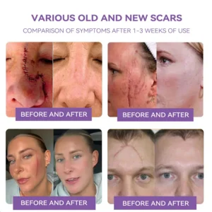 Bostore® hyaluronic acid nano micro-needle regenerating patch image Bostore® hyaluronic acid nano micro-needle regenerating patch