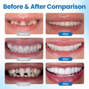 Timilk® SmileMend Tooth Repair Filling Kit