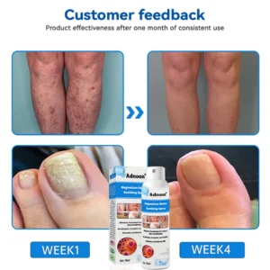 ADNOON Natural Magnesium Herbal Psoriasis Spray