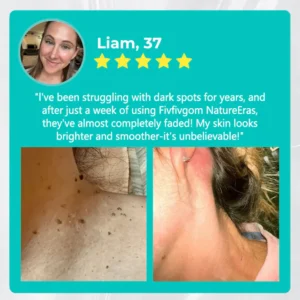 LOVILDS™ NatureErase Instant Mole & Spot Removal Gel image LOVILDS™ NatureErase Instant Mole & Spot Removal Gel