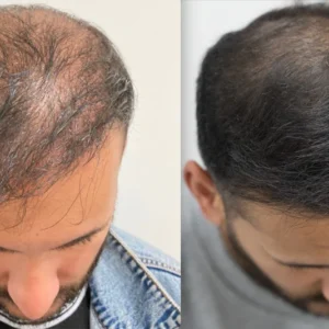 Lovilds® Hair Restoration Spray