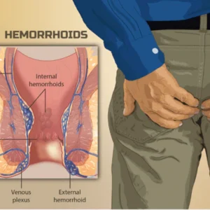 Alisanda™ Hemorrhoids Spray